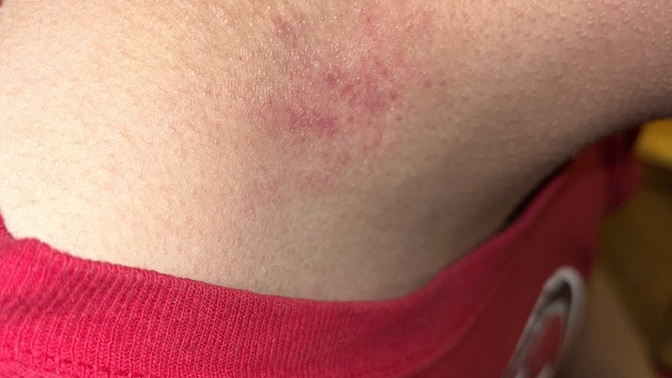 Does my boyfriend have a hickey? (Pic) ?