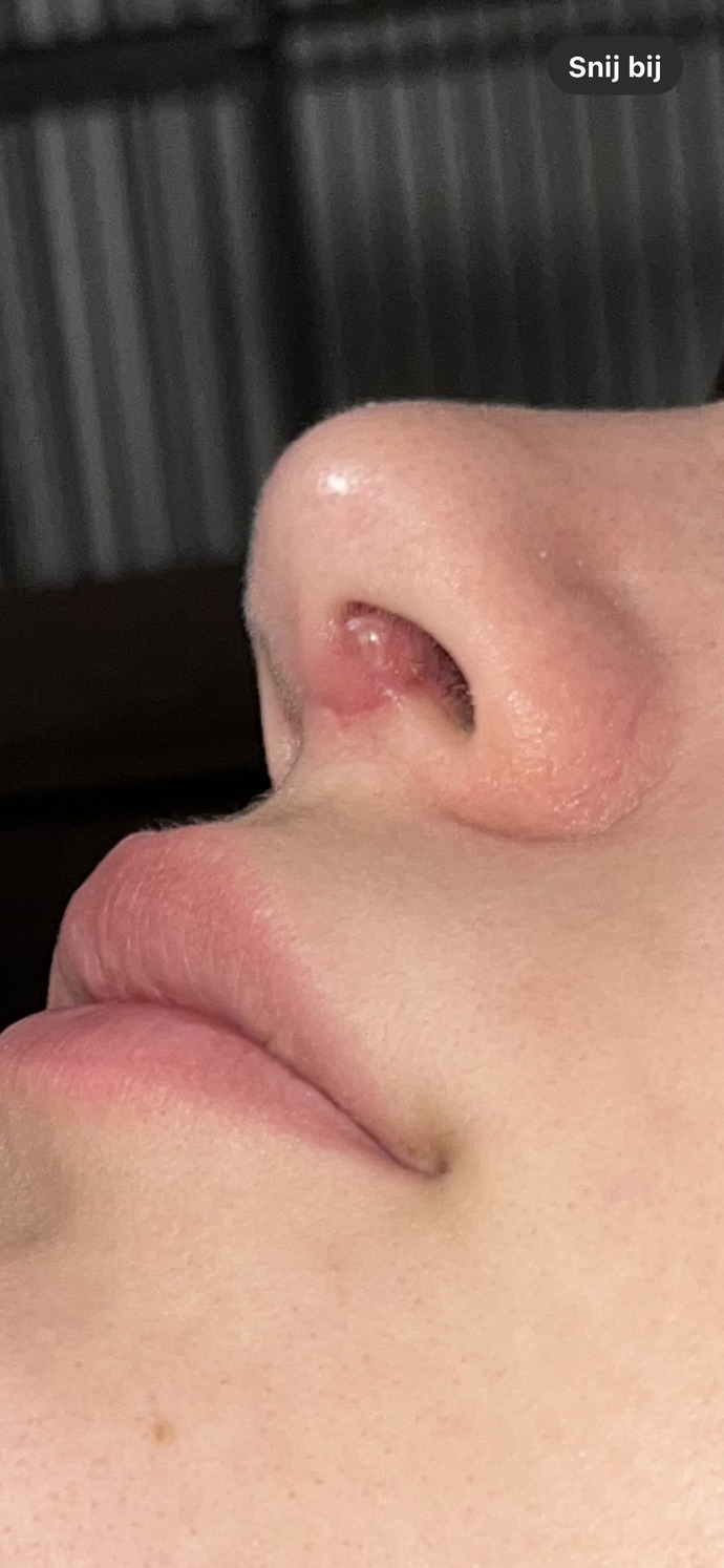 What’s this swelling inside my nose?
