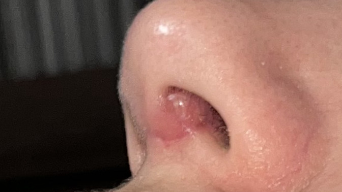 What’s this swelling inside my nose?