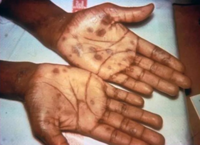 Does Donald Trump Have Syphilis?