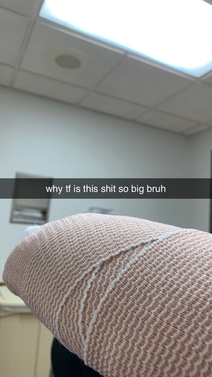 Have you ever broken a bone?
