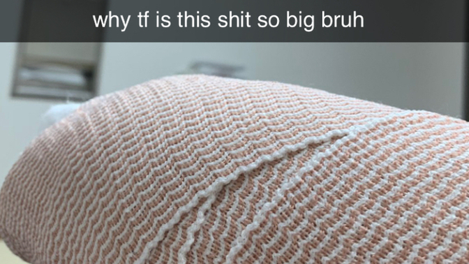 Have you ever broken a bone?
