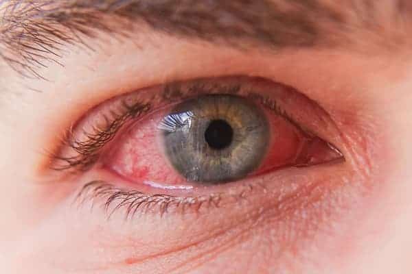How can I relieve my eye pain?