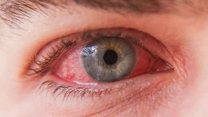 How can I relieve my eye pain?