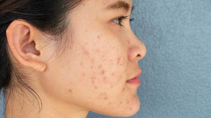 Are girls with acne scars still considered attractive?