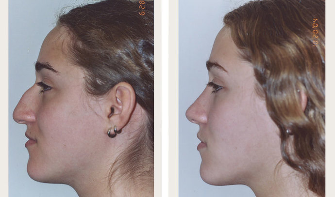 How do you feel about those under 18 wanting plastic surgery?