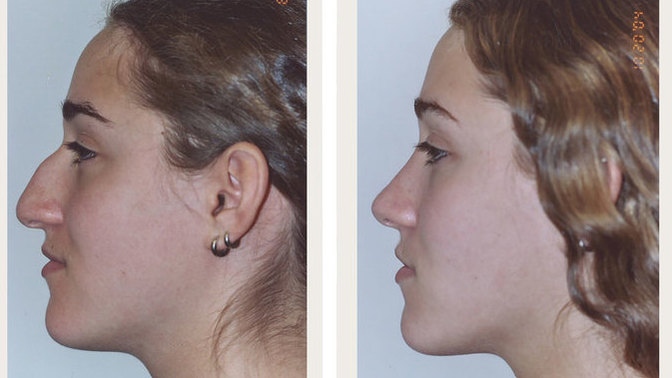 How do you feel about those under 18 wanting plastic surgery?