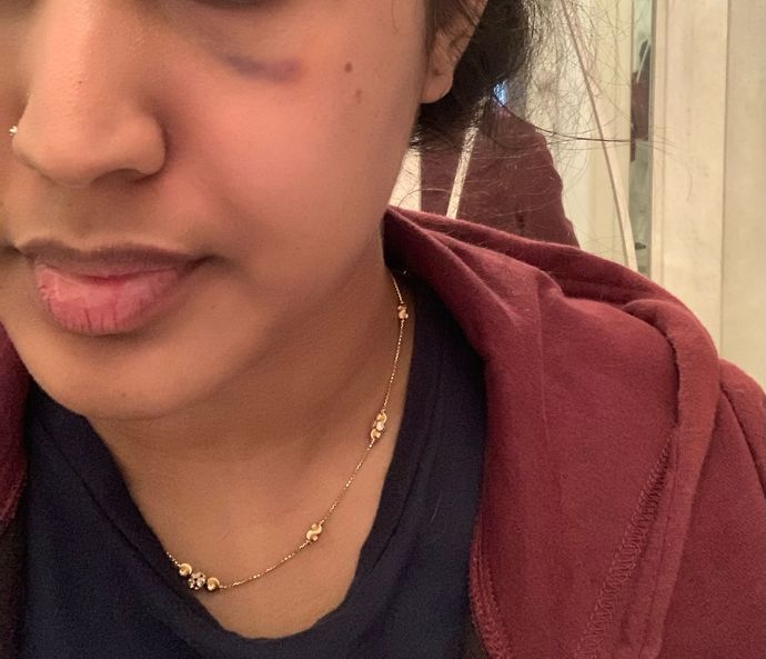 Did prp on my face on the 7th of February. It left a bruise under my eye. Will the bruise go away? Will it leave a scar? When will it go away? ?