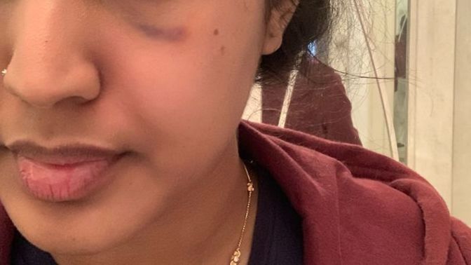 Did prp on my face on the 7th of February. It left a bruise under my eye. Will the bruise go away? Will it leave a scar? When will it go away? ?