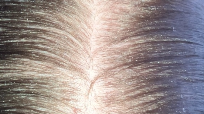 Dandruff and hormone is causing this?