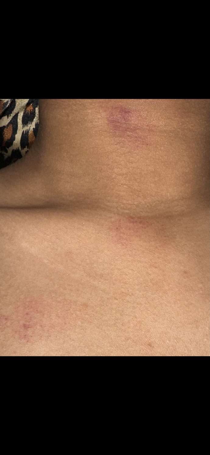 Why did he give me hickeys?