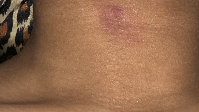 Why did he give me hickeys?