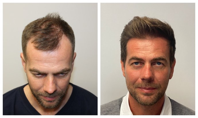 Guys, Do you have a plan for if/when you go bald?