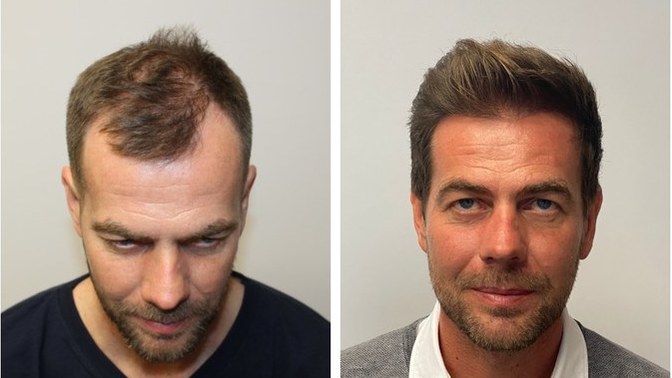Guys, Do you have a plan for if/when you go bald?