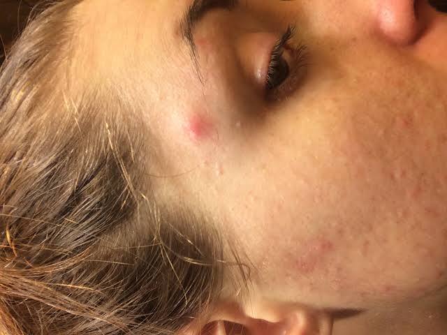 Which one is more annoying? cold sores on lips or pimples on temples?