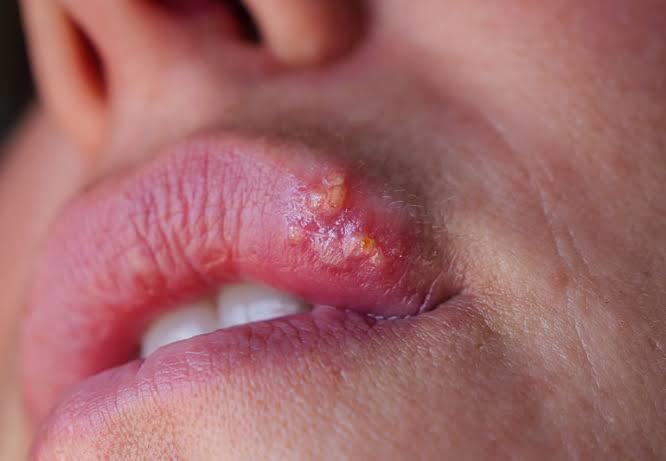 Which one is more annoying? cold sores on lips or pimples on temples?