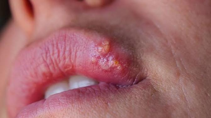 Which one is more annoying? cold sores on lips or pimples on temples?