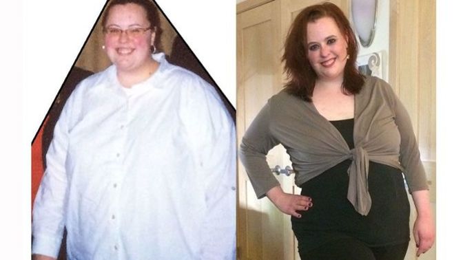 What do you think about people who get weight loss surgery?
