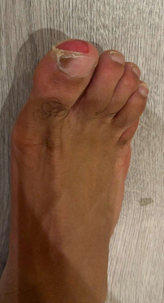 My foot is injured. How does it heal?