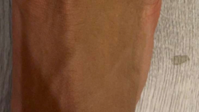 My foot is injured. How does it heal?