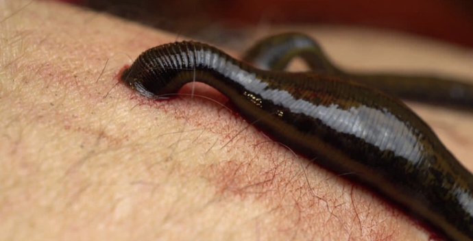 Have you ever had leeches?