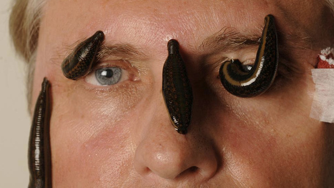 Have you ever had leeches?