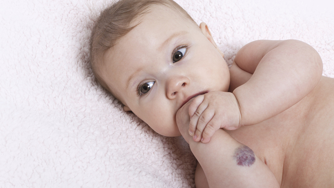 Do you have birthmark? If yes, where?