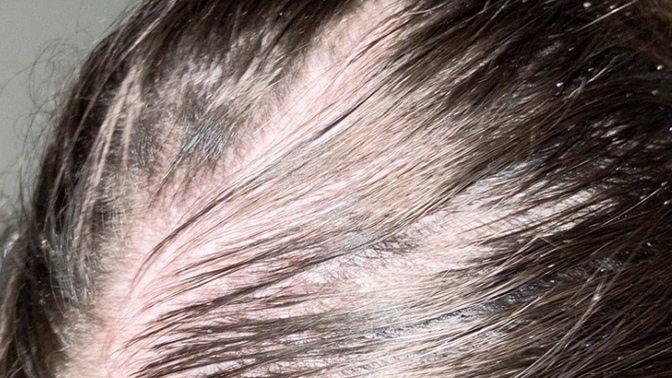 Is my dandruff causing this?