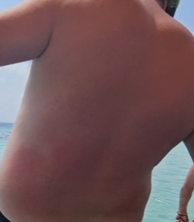 Is it possible to overtime develop an immunity to sunburn?
