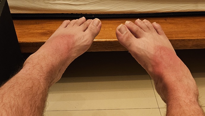 Is it possible to overtime develop an immunity to sunburn?