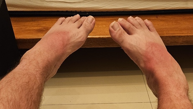 Is it possible to overtime develop an immunity to sunburn?
