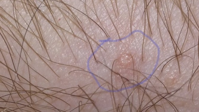 Found a small skin color bump on wrist, is that anything to worry about?