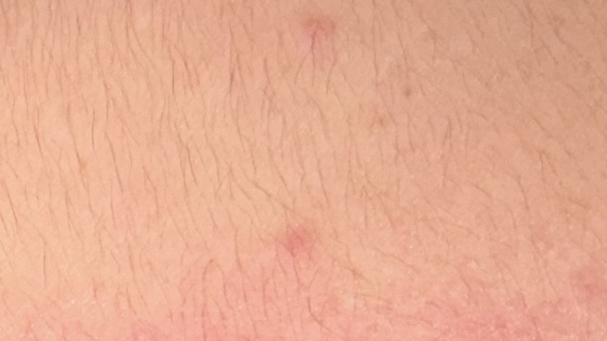 Ok so I have had a chest xray very recently everything is normal however?
