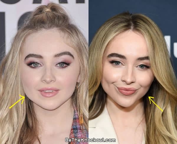 Does Sabrina Carpenter look better before or after her plastic surgery/fillers?