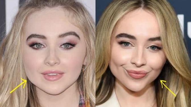 Does Sabrina Carpenter look better before or after her plastic surgery/fillers?