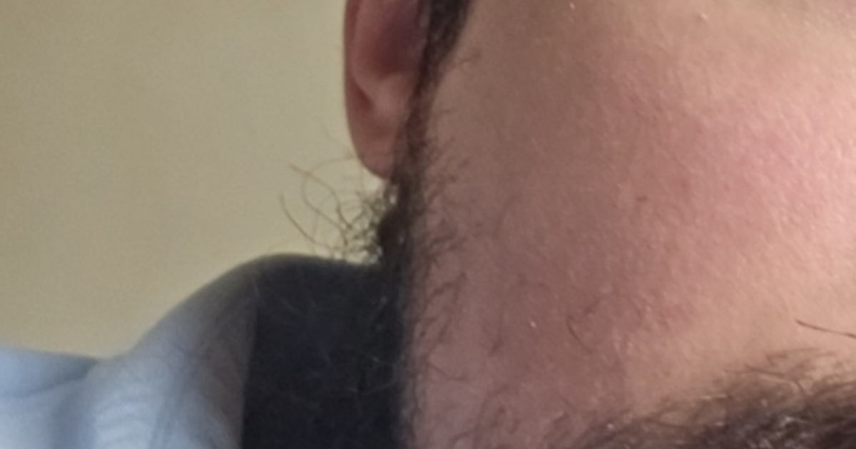 Is red cheeks on a guy 