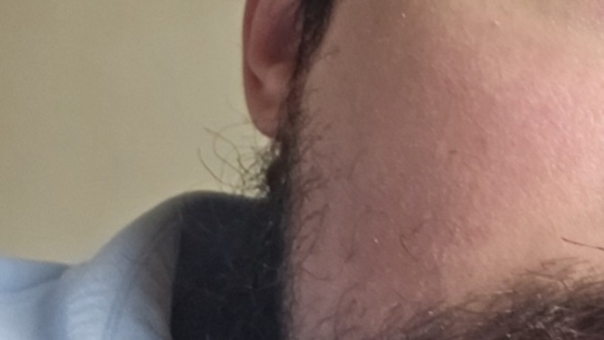 Is red cheeks on a guy "unattractive" and would it put you off?