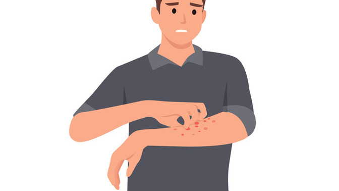Has anyone else struggled with eczema?