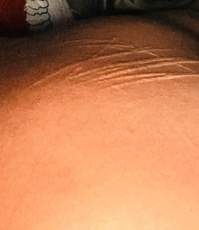 Does anyone know how to treat this? it gets itchy, most at night. it is so uncomfortable?