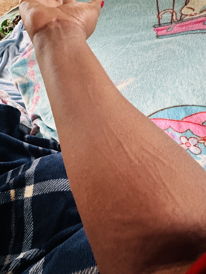 Does anyone know how to treat this? it gets itchy, most at night. it is so uncomfortable?