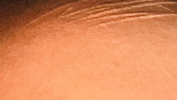 Does anyone know how to treat this? it gets itchy, most at night. it is so uncomfortable?
