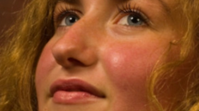 Thoughts on Rosy/Red Cheeks?