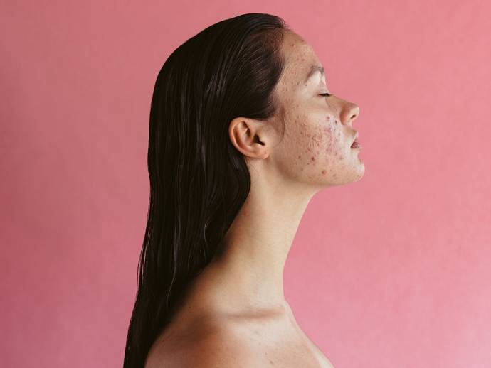 What do you think about hormonal acne on a girl?