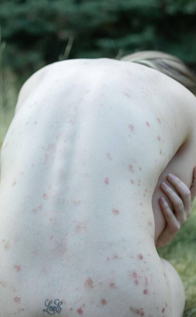 What do you think about hormonal acne on a girl?