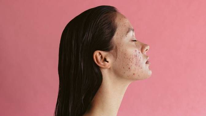 What do you think about hormonal acne on a girl?