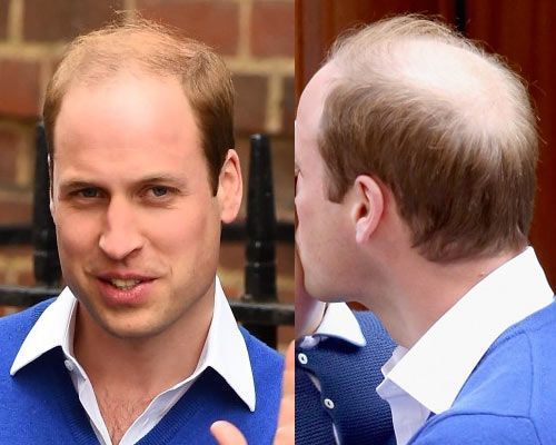 Should men who are balding just shave that thing already?