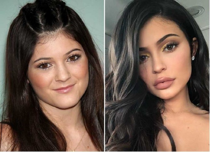 I dont think she needed plastic surgeries but Western people differ 🤔
