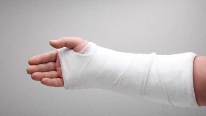 Have you ever broken a bone?