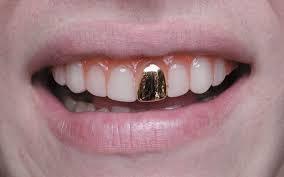 If you were to get a gold tooth cap grill as a style look, which placement you would get the cap on?