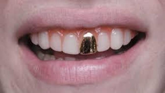 If you were to get a gold tooth cap grill as a style look, which placement you would get the cap on?